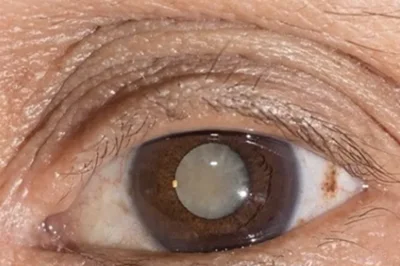 糖尿病性白内障
