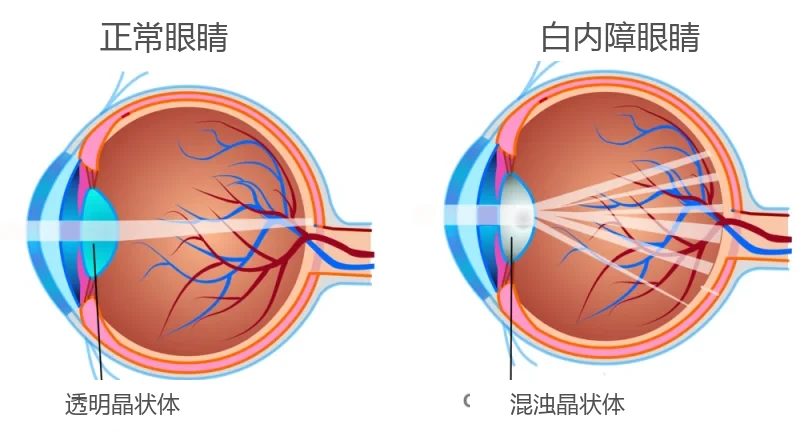 正常眼睛与白内障眼睛对比