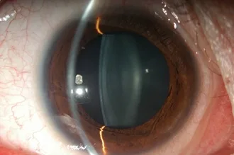 皮质性白内障晶状体混浊示意图